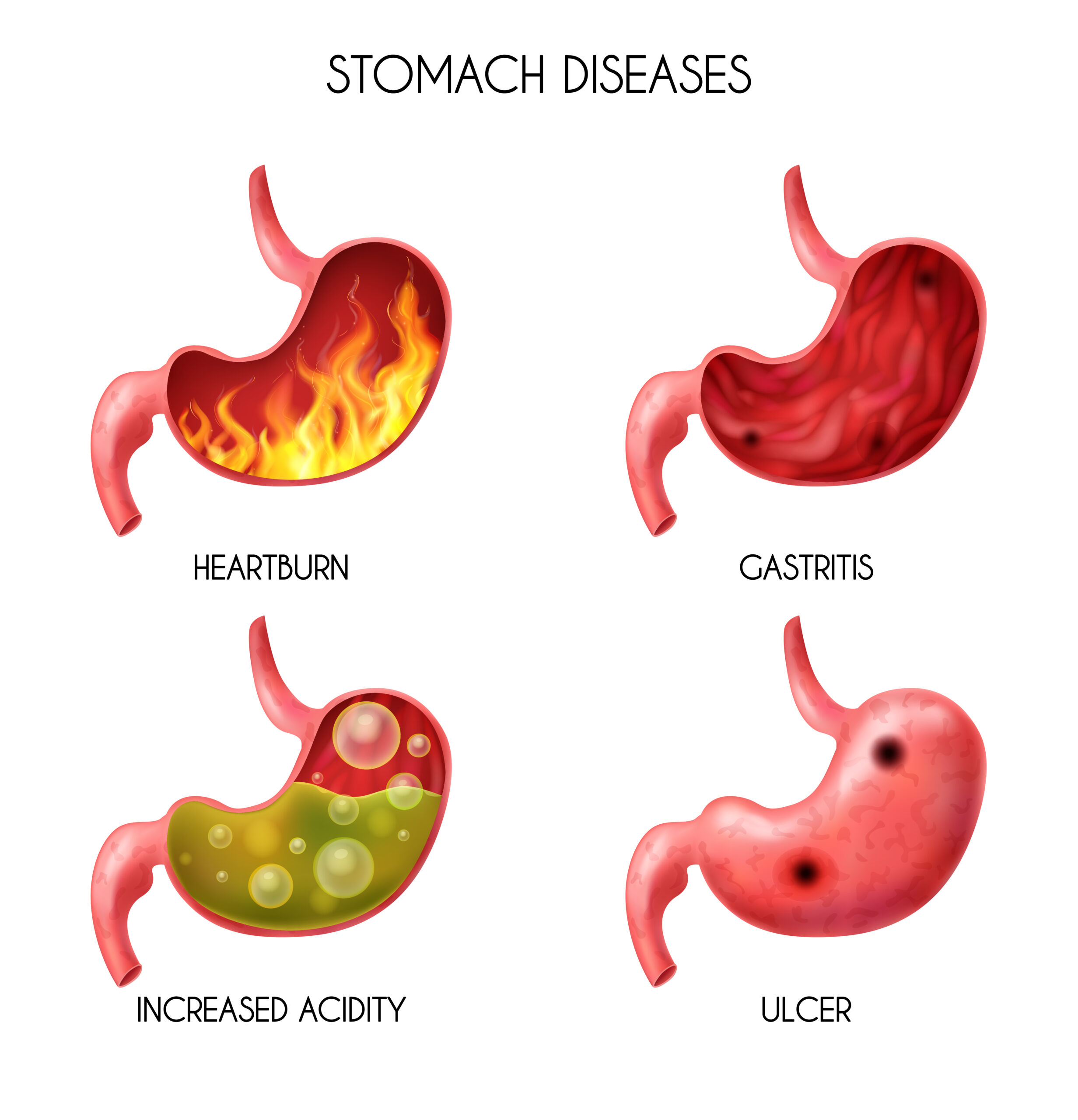 Best Gastritis treatment in ahmedabad