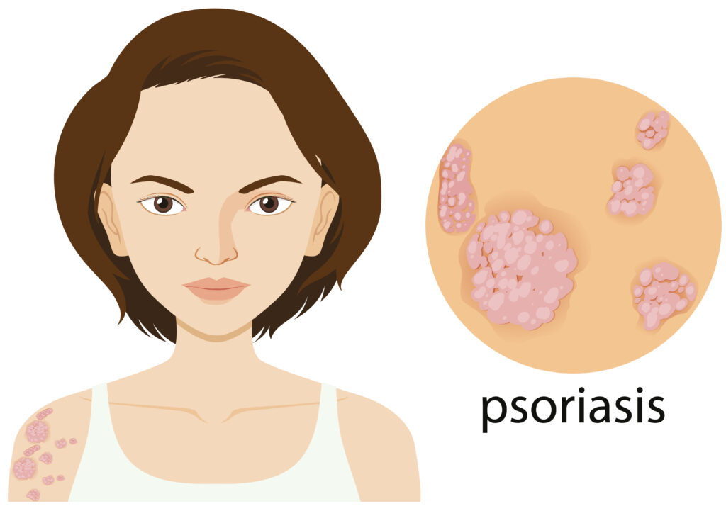 Best Ayurvedic Treatment for Psoriasis in Ahmedabad