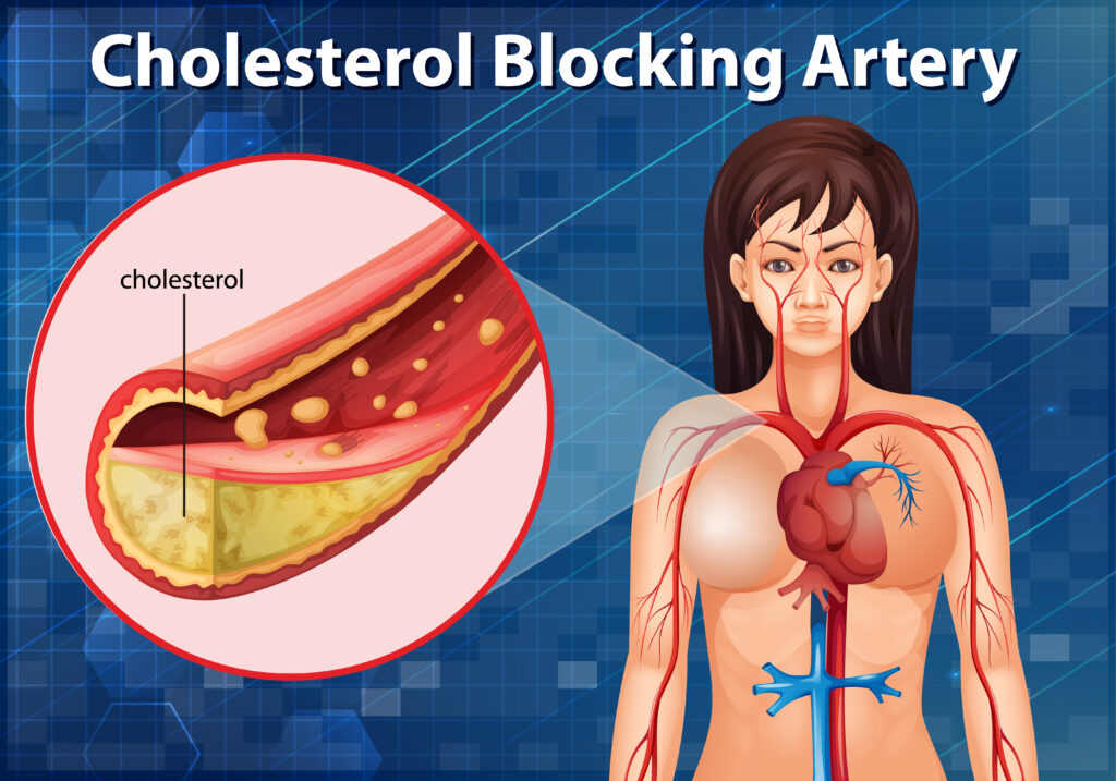 Best Cholesterol Treatment In Ahmedabad