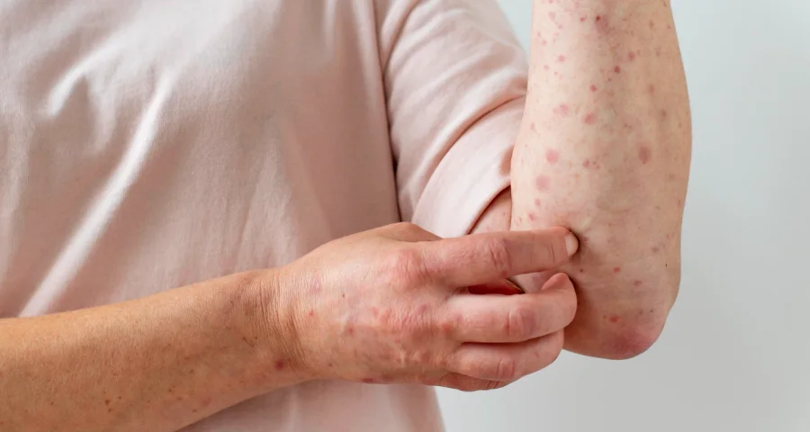 Ayurvedic psoriasis and skin treatment in Ahmedabad